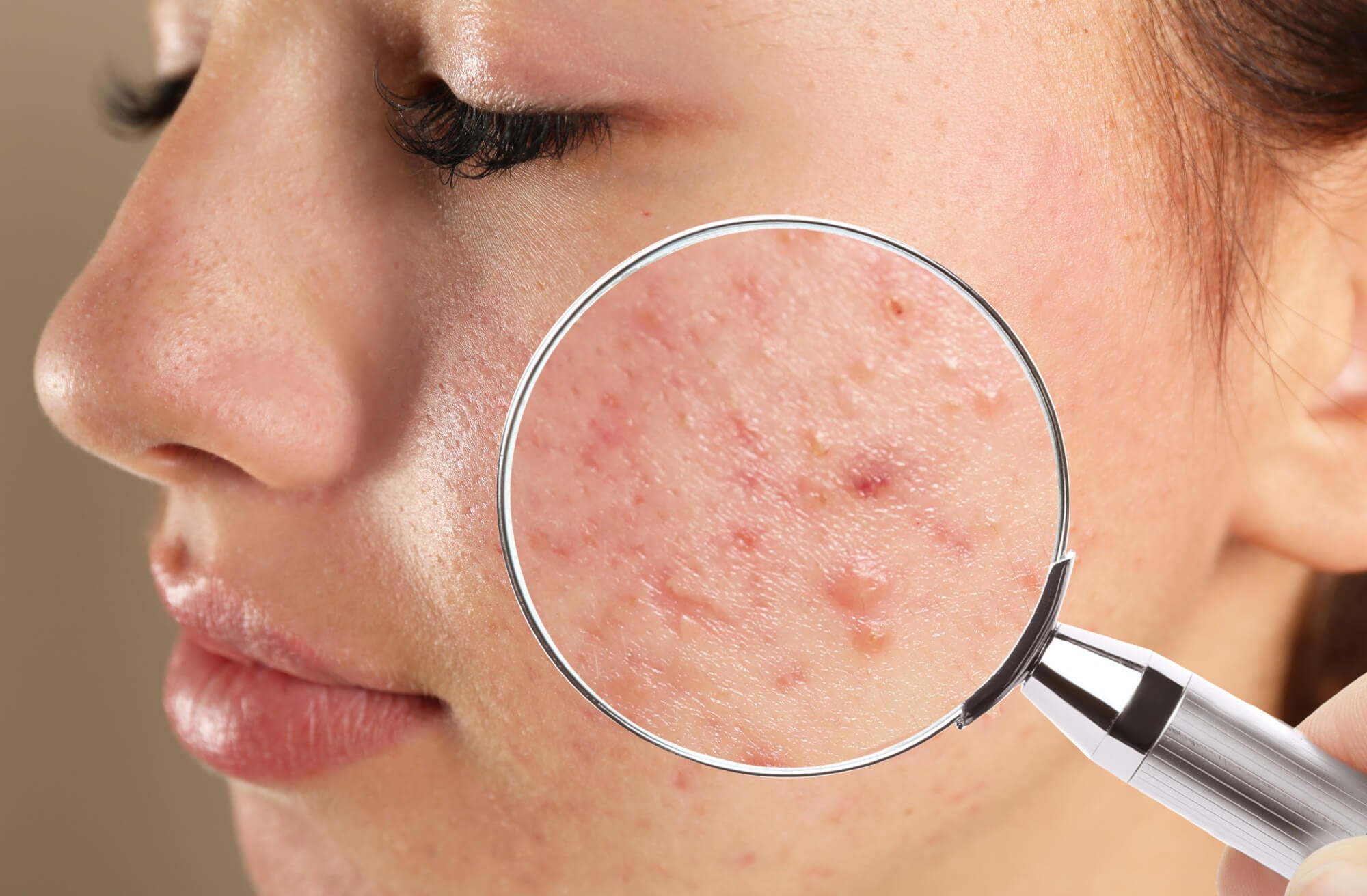 Roaccutane is the best for acne?