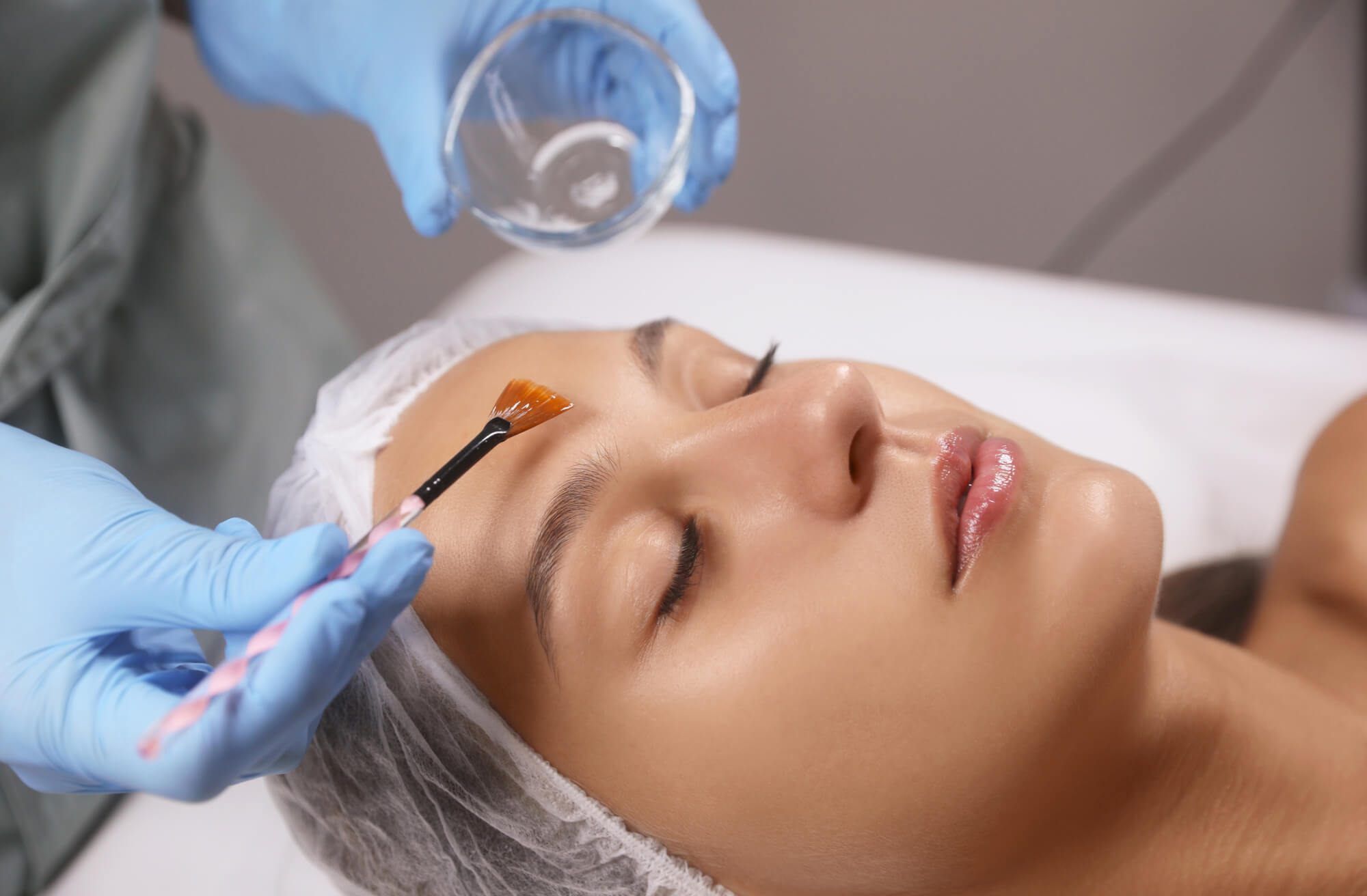 Chemical Peels; the low-down