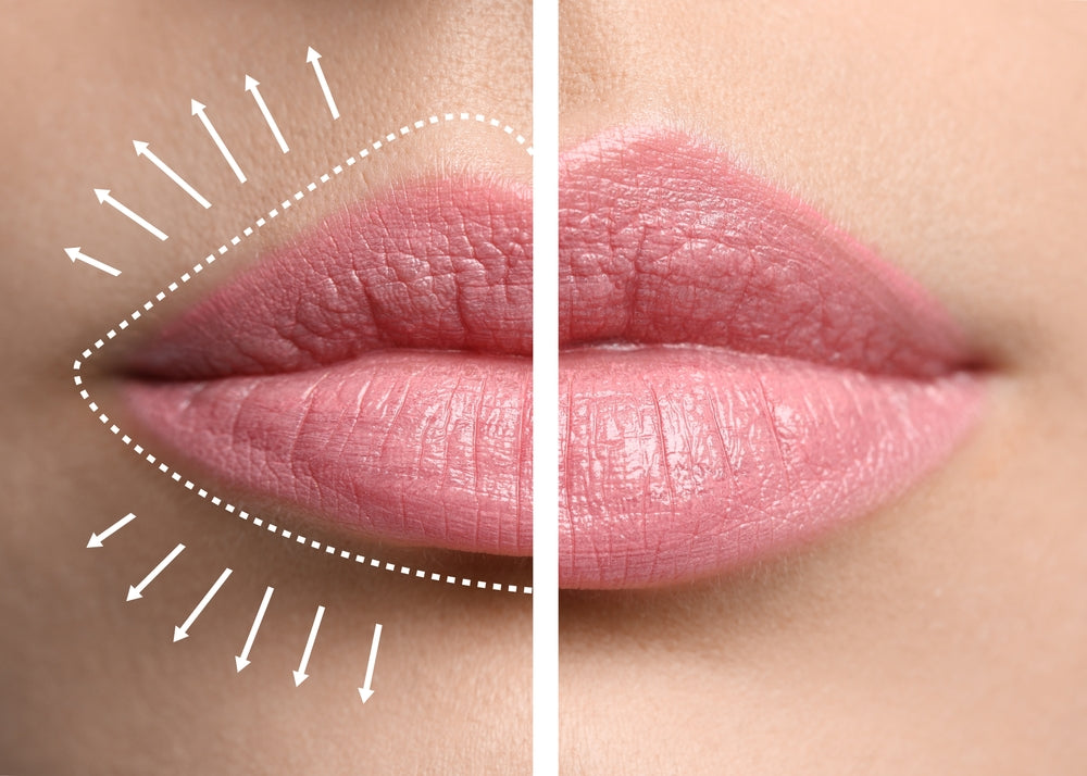 No Needle Lip Lift