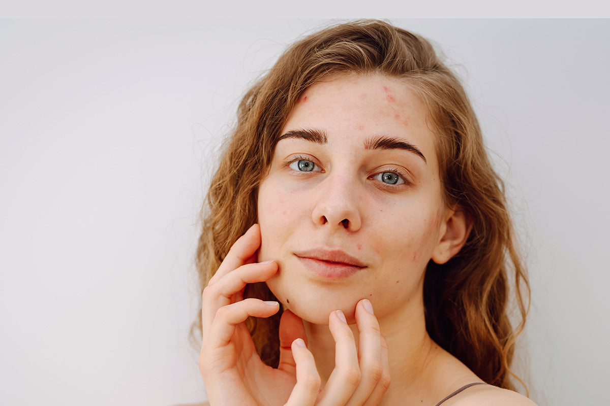 The sensitive skin guide: how to calm flare ups and manage skin sensitivity