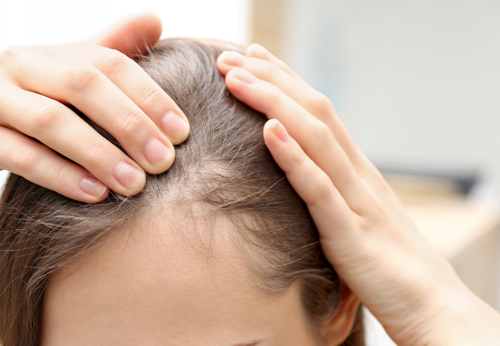 Female Hair Thinning and Hair Loss