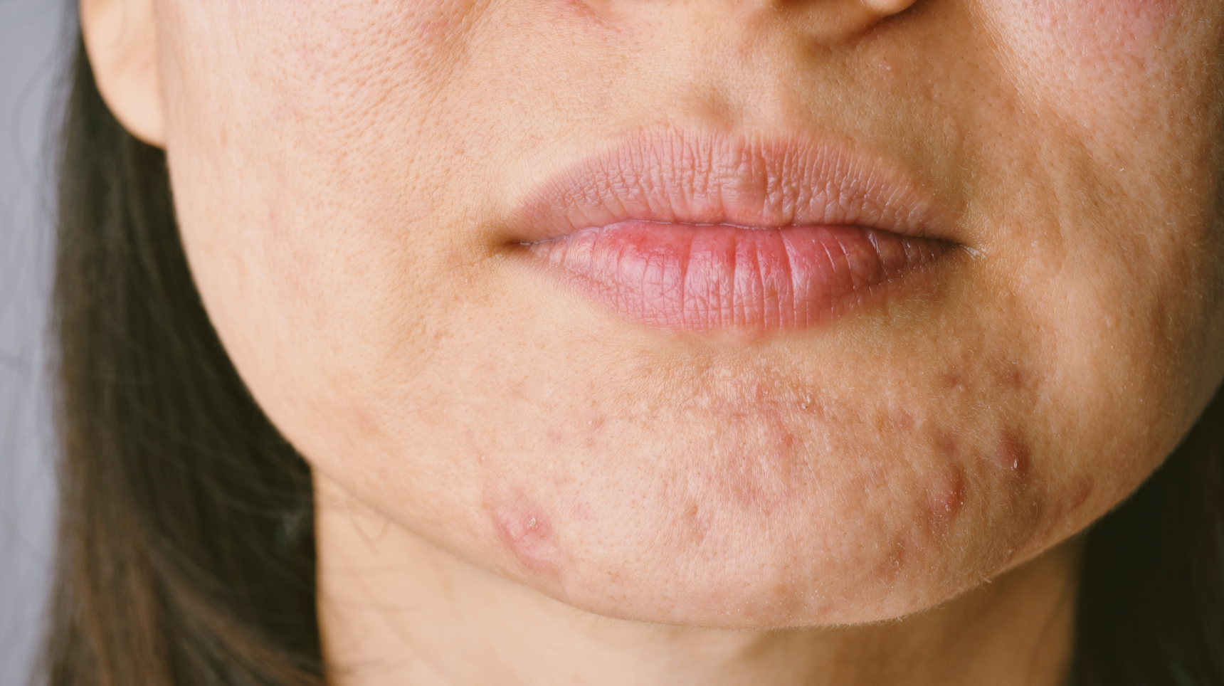 Roaccutane is the best for acne?