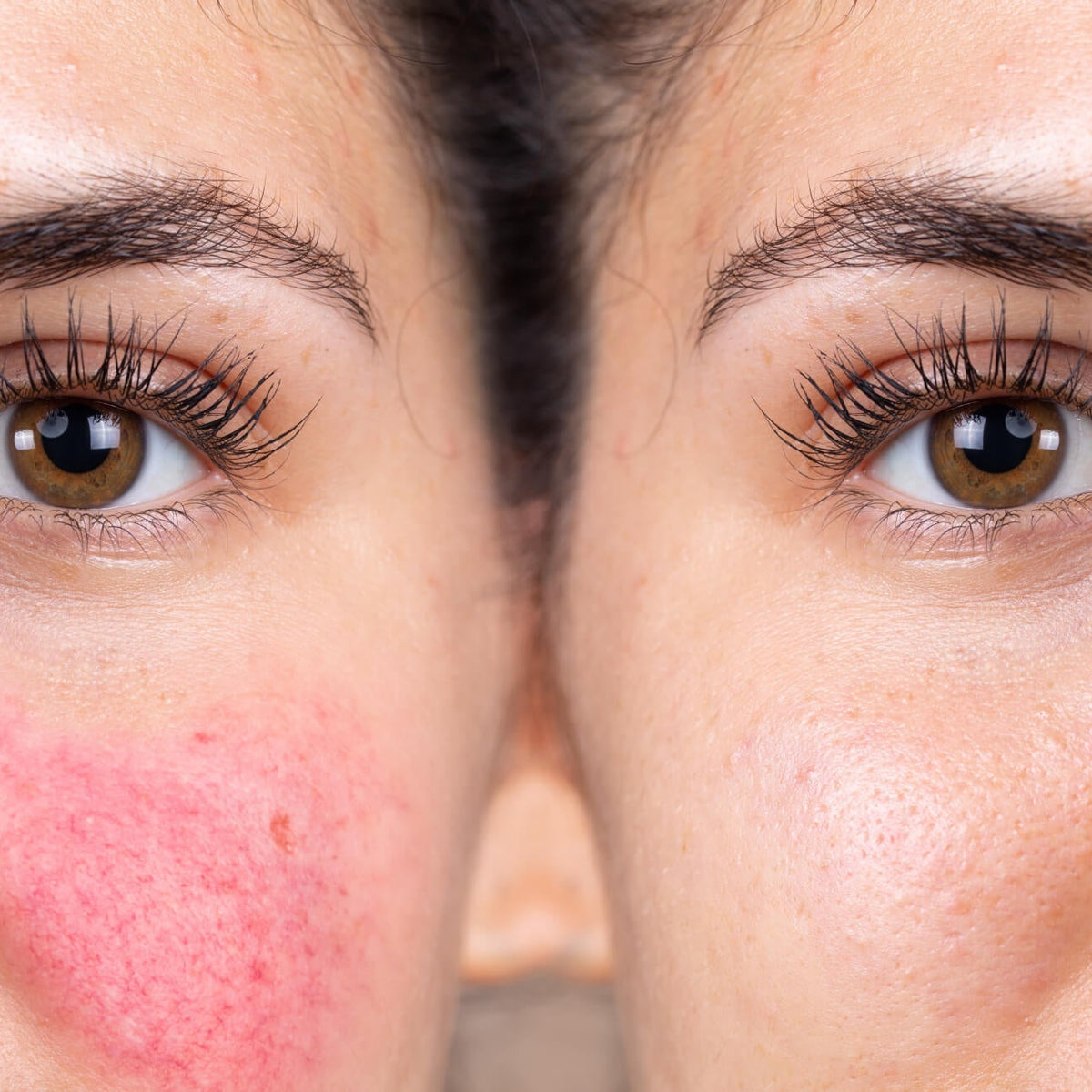 glutathione rosacea The Latest on Rosacea
