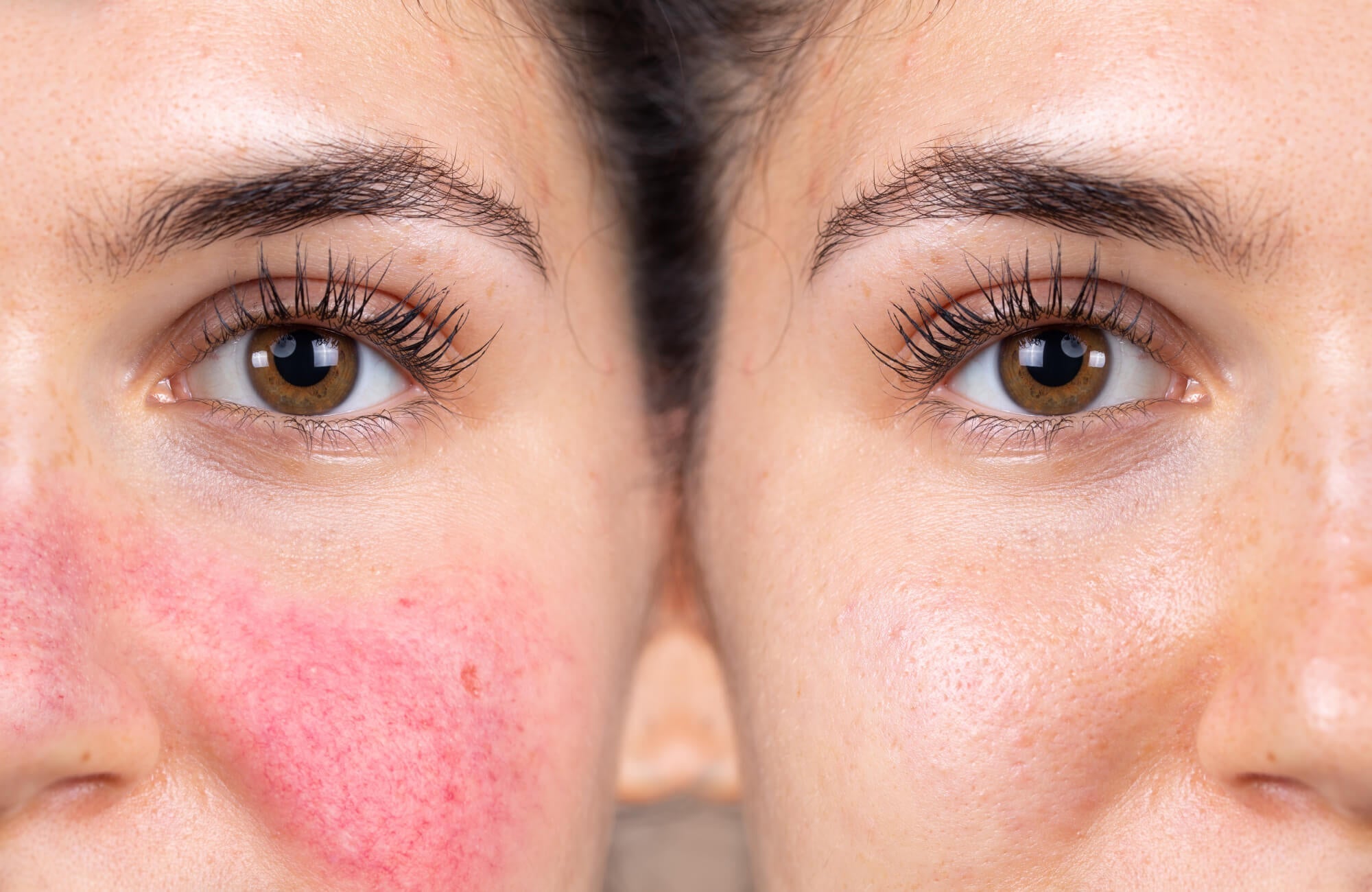 woman with rosacea before and after