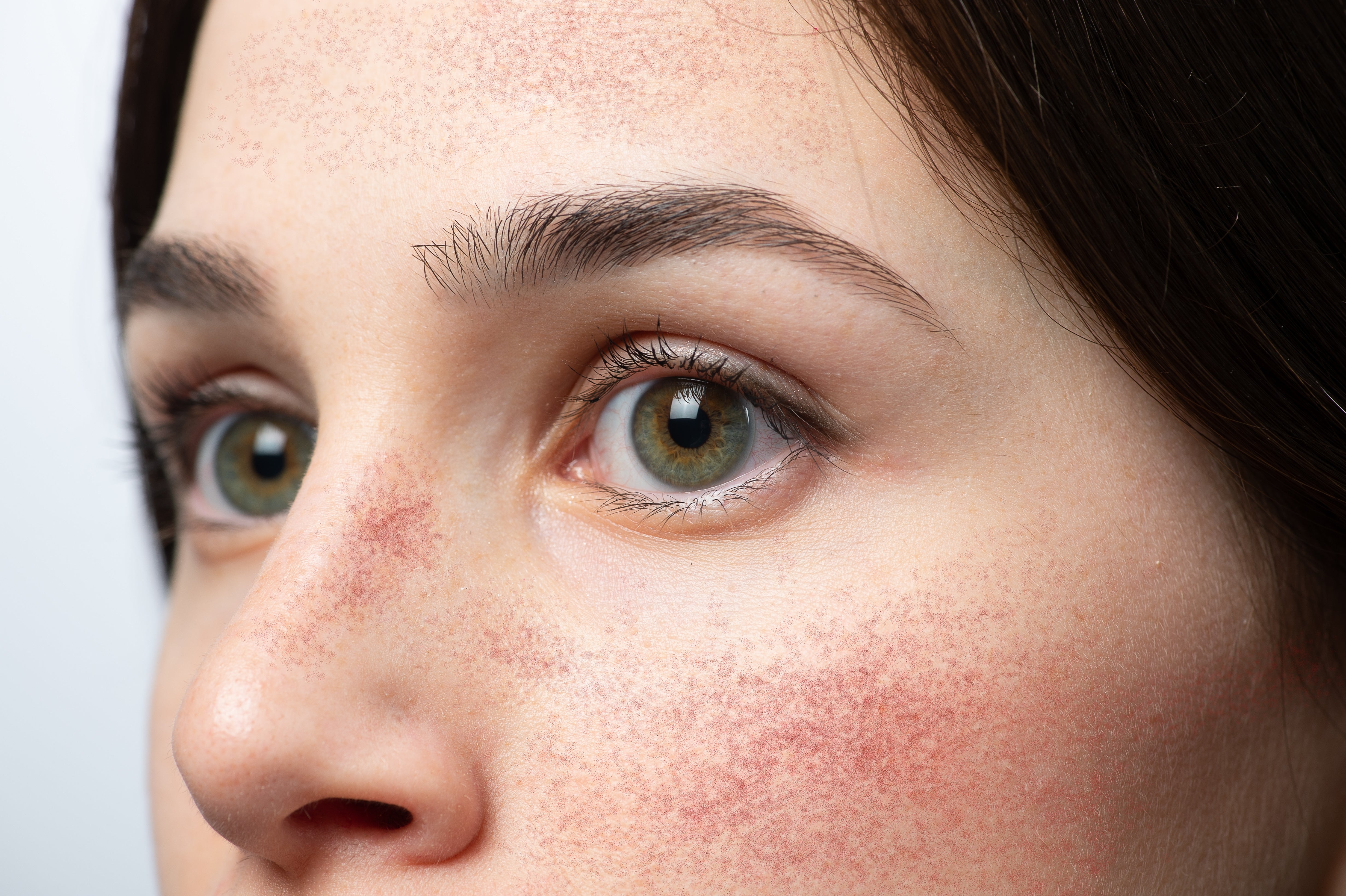 Ask the Derm: Rosacea