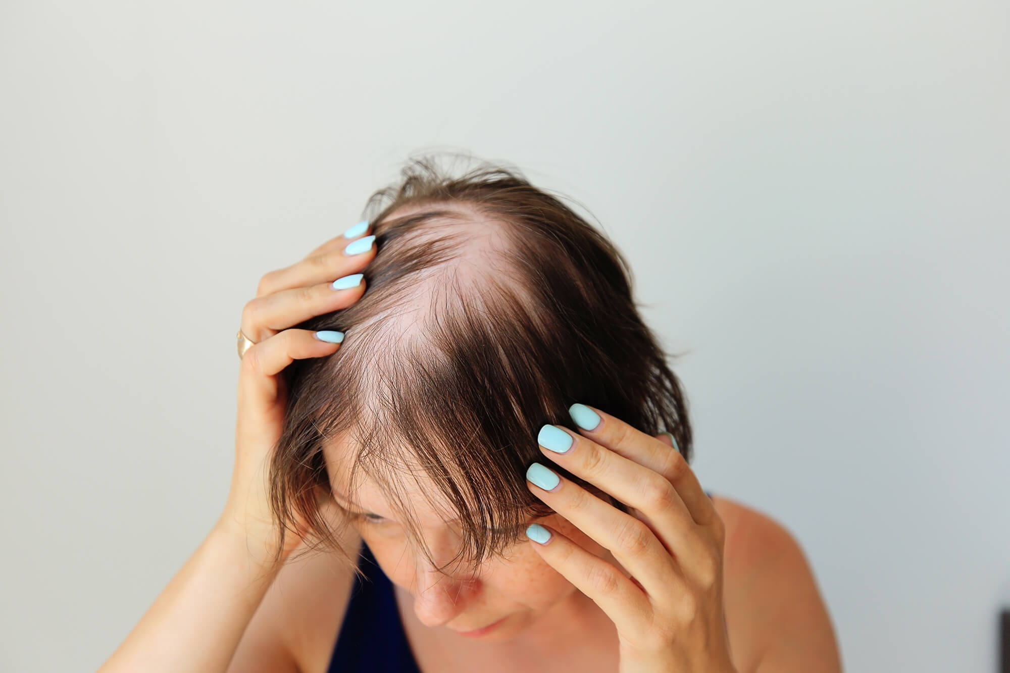 Derm School: Female Pattern Hair Loss